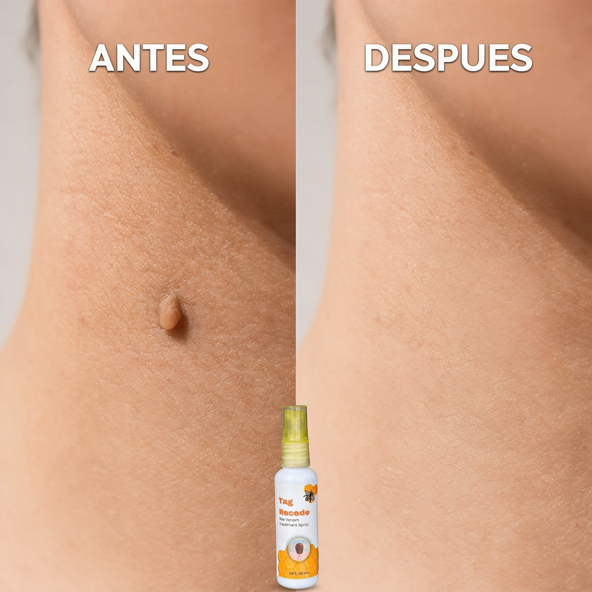 "Dile adios a las verrugas desde casa sin procedimientos invasivos"